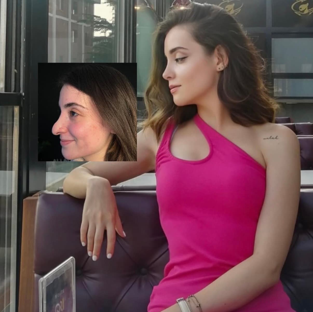 Rhinoplasty before and after