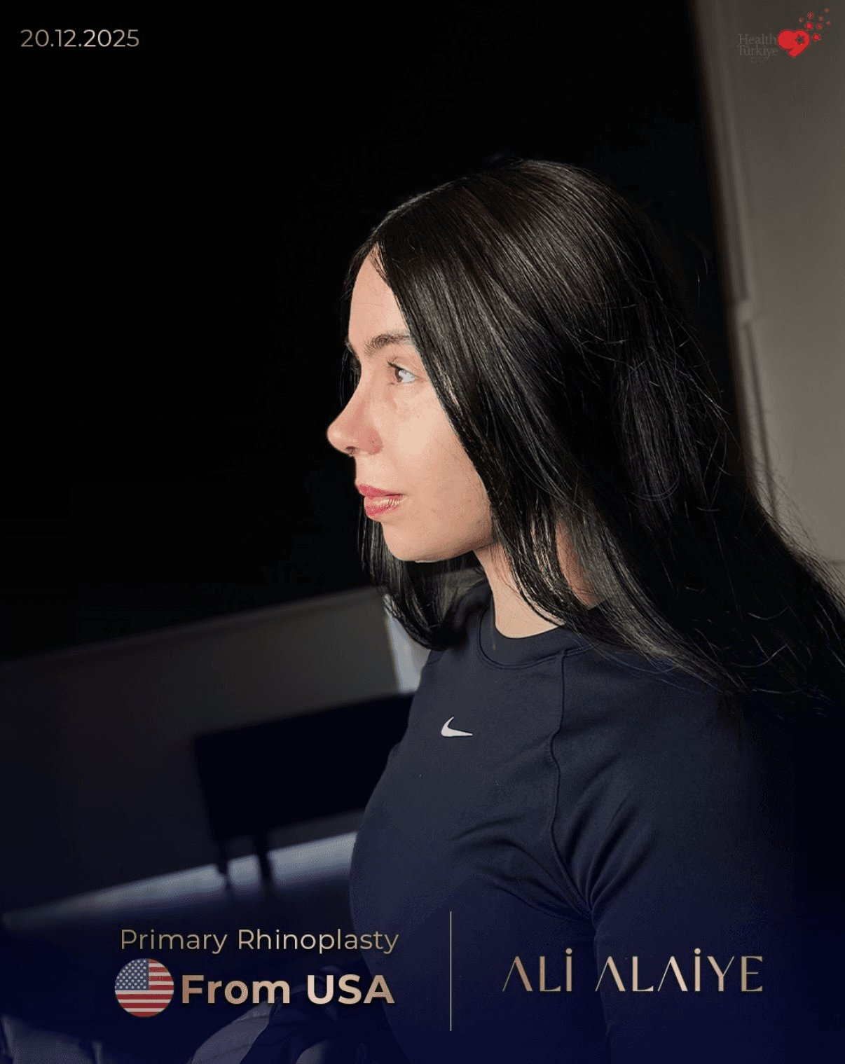 Rhinoplasty before and after