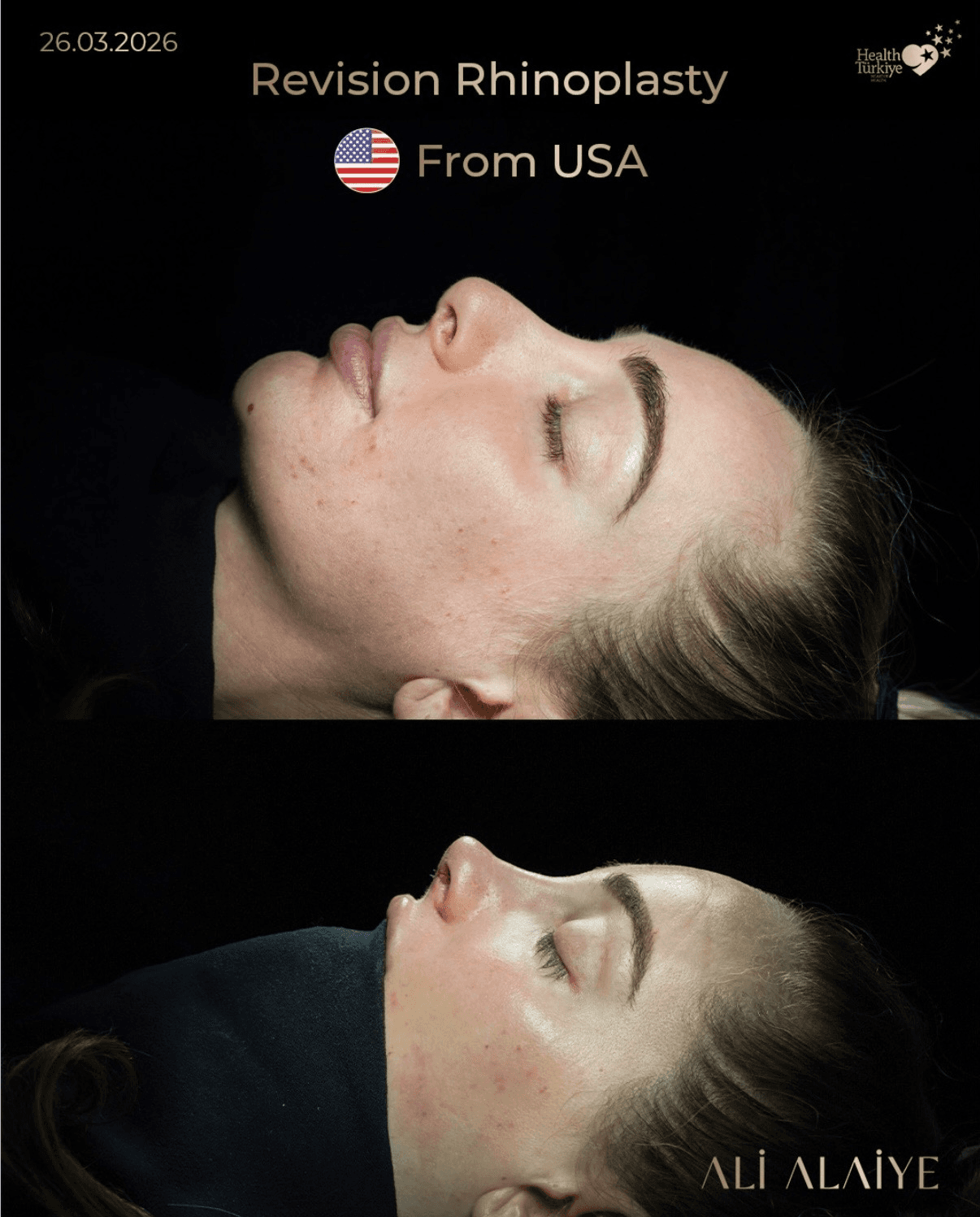 Rhinoplasty before and after