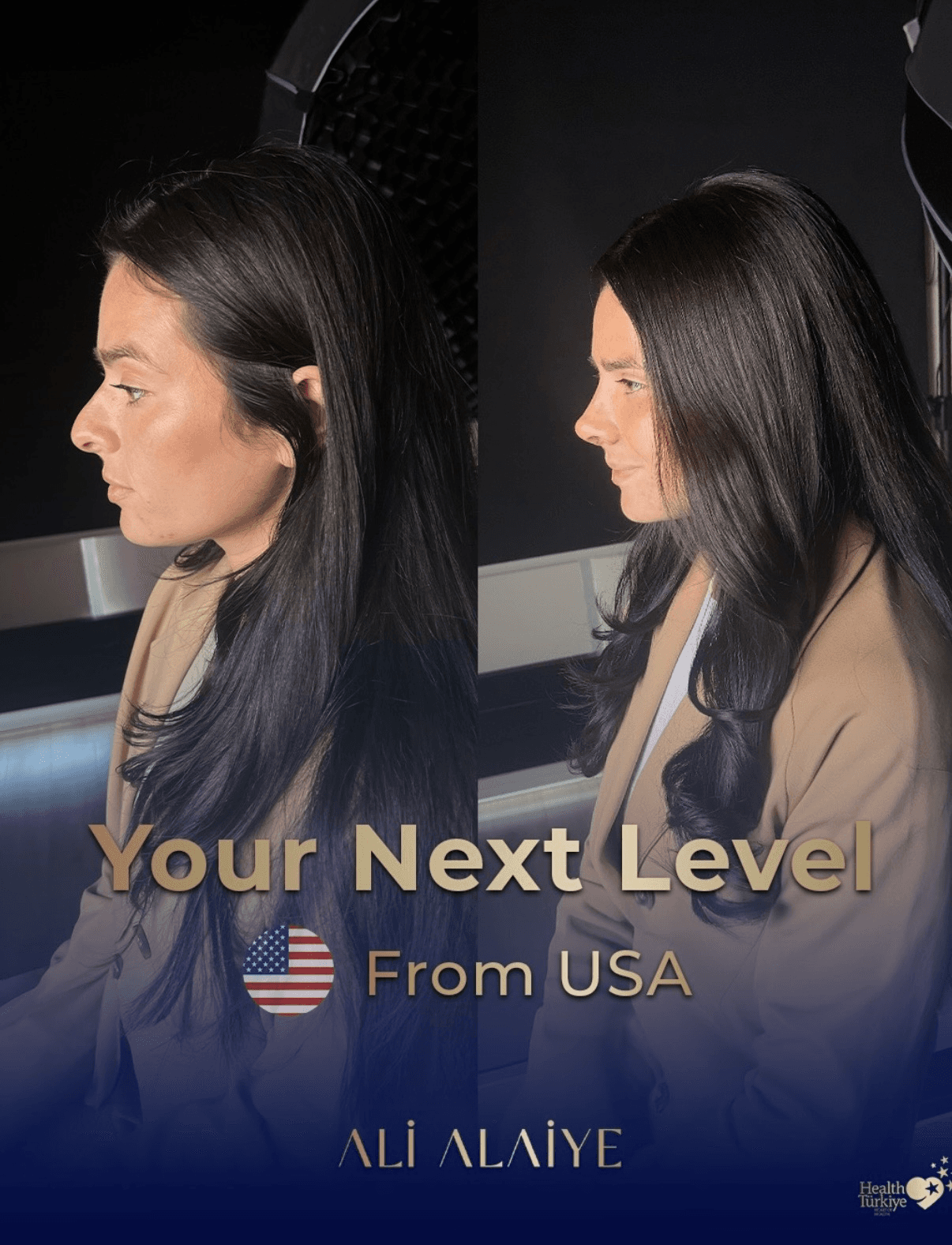 Rhinoplasty before and after