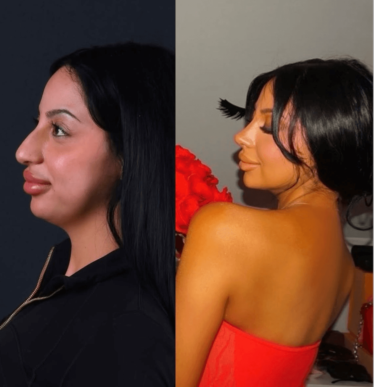 Rhinoplasty before and after