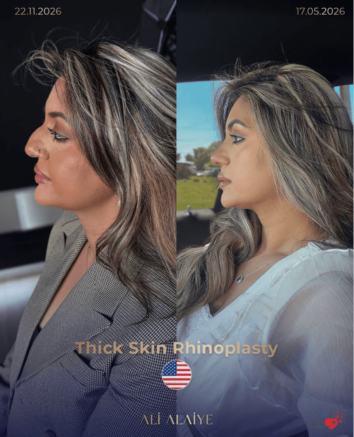 Rhinoplasty before and after