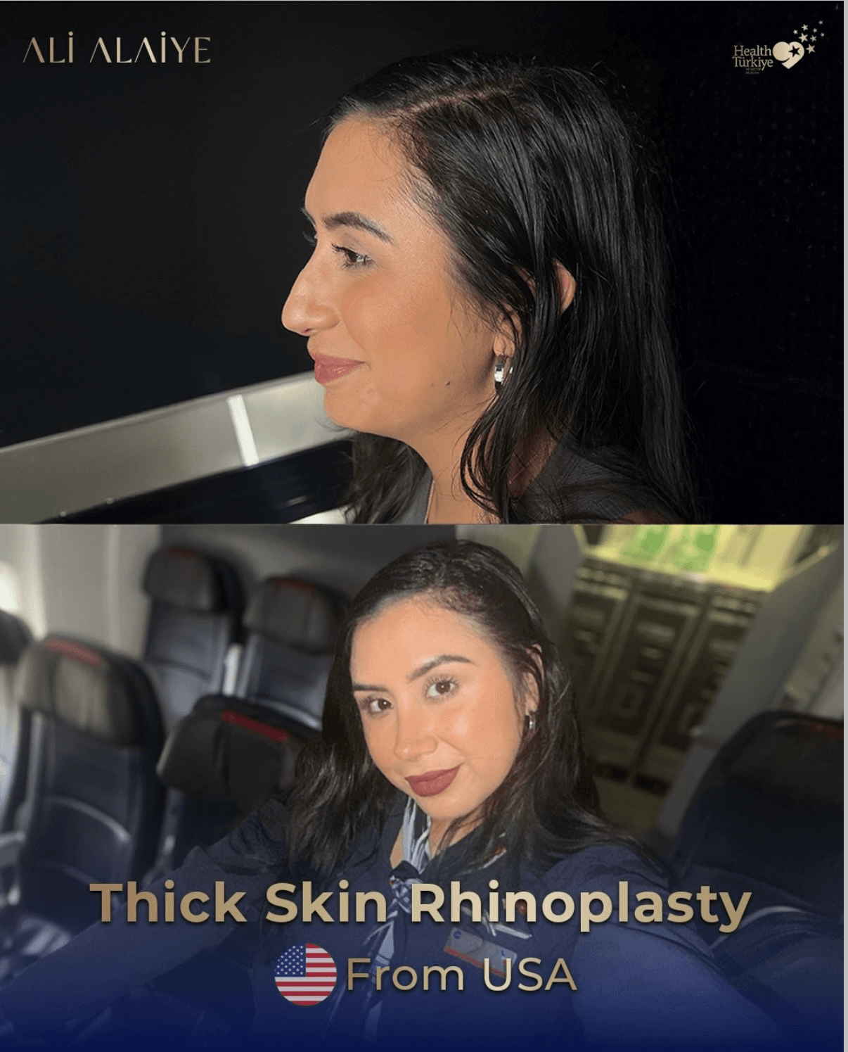 Rhinoplasty before and after